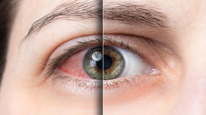 Göz alerjisine dikkat: Kornea ülserine neden olabilir